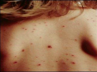 Two More Measles Cases In Massachusetts