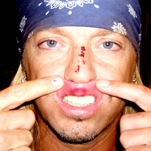 re: Bret Michaels' Issues His Own Response To Tony Award Injury
