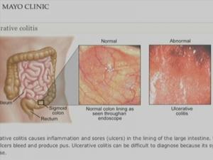 Ulcerative Colitis Could Lead To Colon Cancer