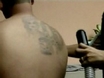 Former Gang Members Remove Once Prized Tattoos