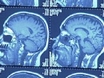 A Look at Traumatic Brain Injury